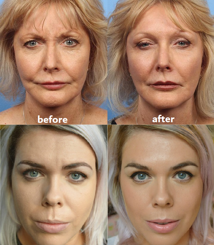 Patchs réutilisables pour visage et cou – 11 ou 16 pièces