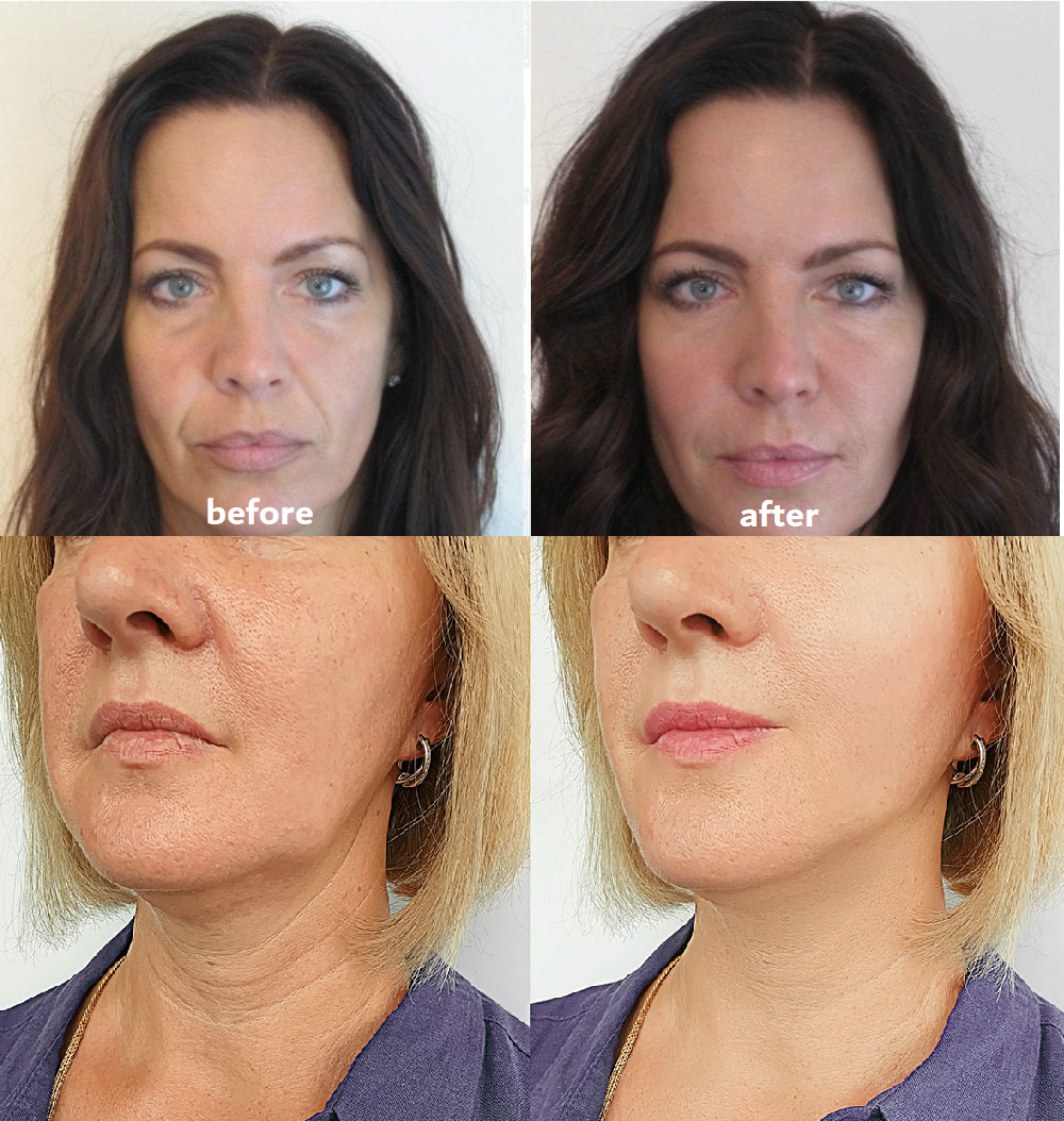 Patchs réutilisables pour visage et cou – 11 ou 16 pièces