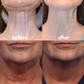 Patchs réutilisables pour visage et cou – 11 ou 16 pièces