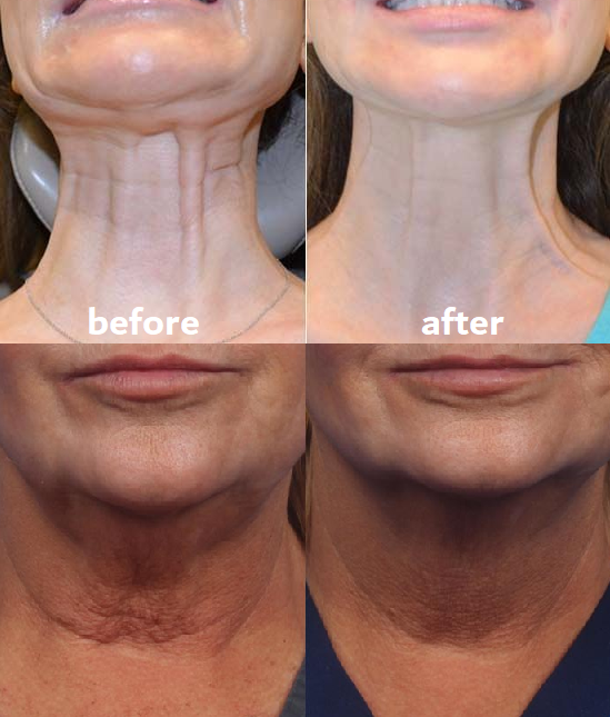 Patchs réutilisables pour visage et cou – 11 ou 16 pièces