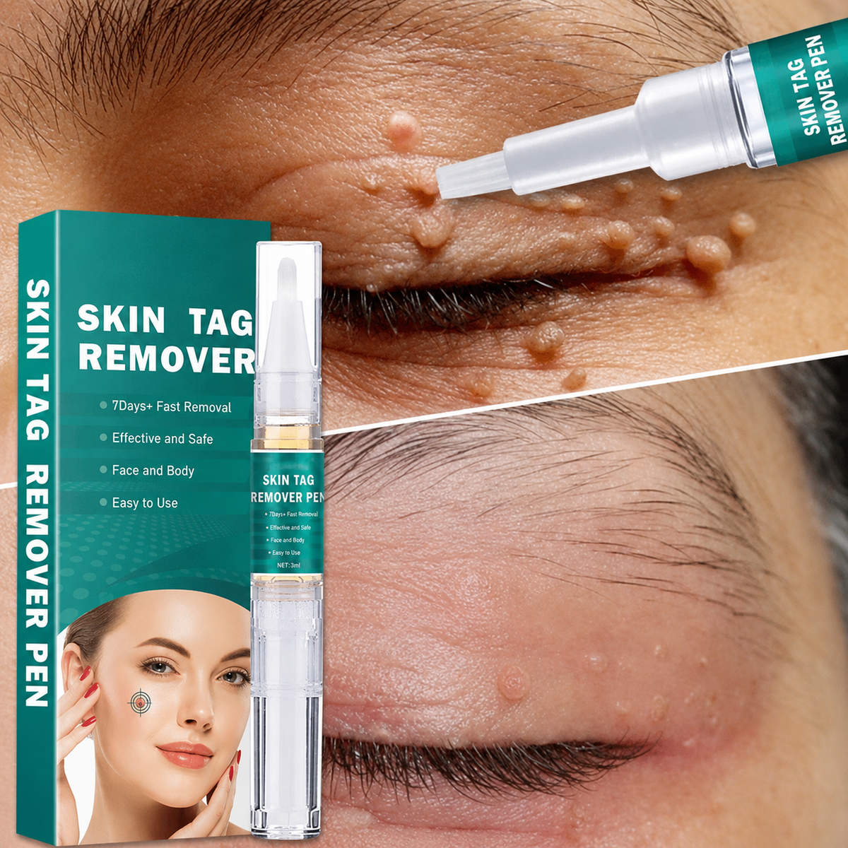Stylo applicateur pour acrochordons