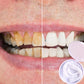Facettes dentaires amovibles cosmétiques
