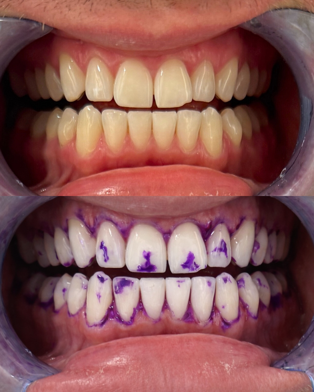 Bandes de blanchiment dentaire flexibles – 14 pièces
