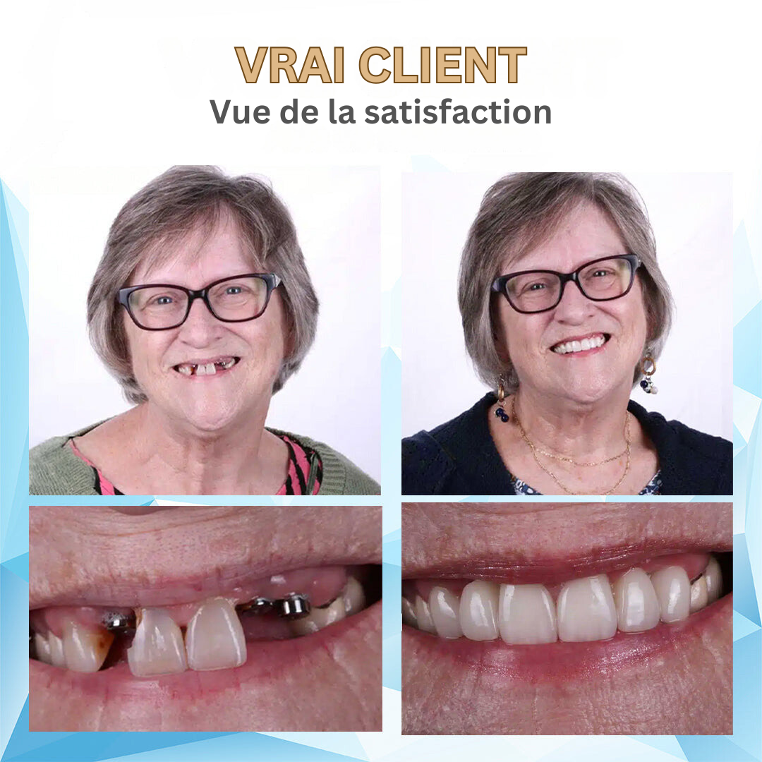 Facettes dentaires cosmétiques amovibles avec bandes de moulage